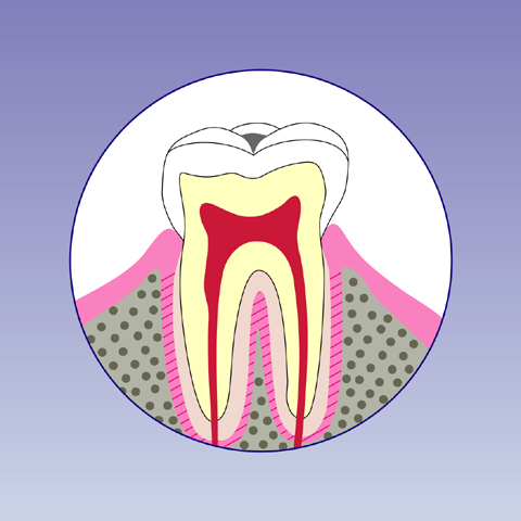 C1【エナメル質の虫歯】