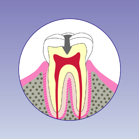 C2【象牙質の虫歯】