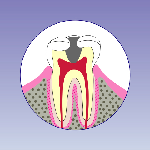 C3【神経まで達した虫歯】