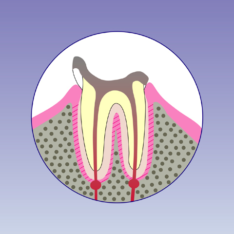 C4【歯根まで達した虫歯】